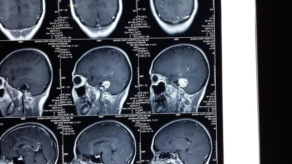 例2术前增强mri(矢位):右侧桥小脑角听神经瘤