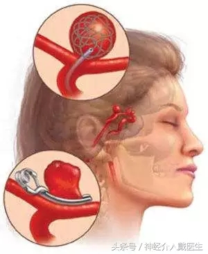 关于颅内动脉瘤的一些要点,你知道多少?