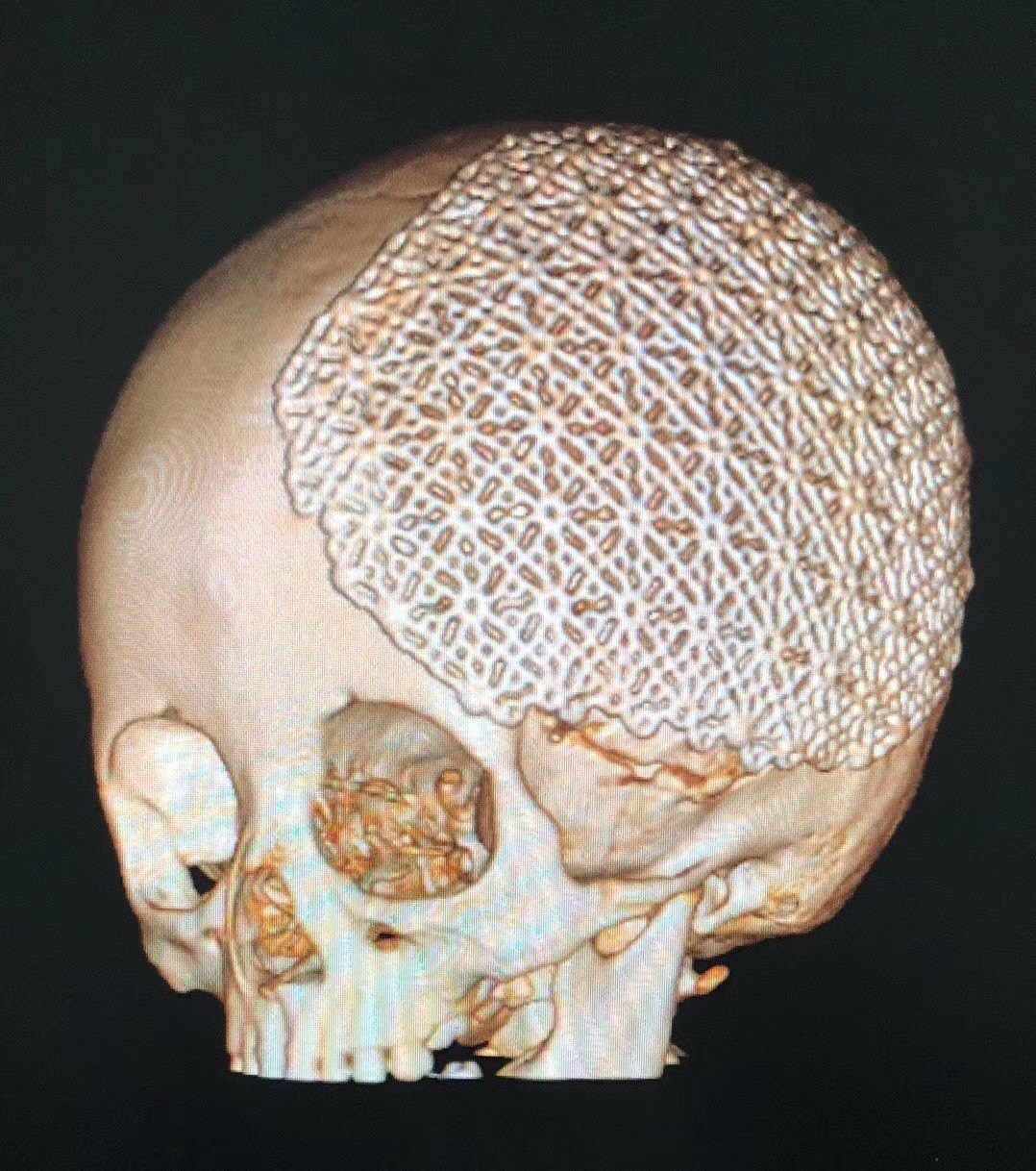 儿童颅骨缺损的手术治疗(颅骨修补术)_王举磊医生文章_唐都医院-微医