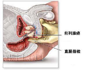 诊就是医生将戴手套的手指伸入患者直肠,并隔着直肠触摸前列腺的检查