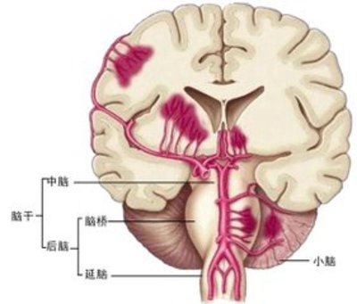 脑干出血发病时可以采取哪些应急处理