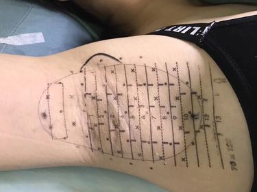 新一例微波治疗腋臭