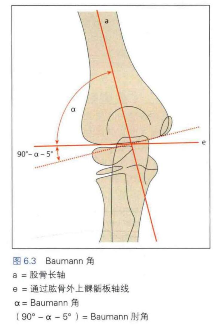 【知识点1:肱骨长轴与肱骨外侧骨骺的夹角称为baumann角,肱骨长轴垂线