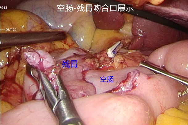 完全腹腔镜下近端胃大部切除术(双通道消化道重建)
