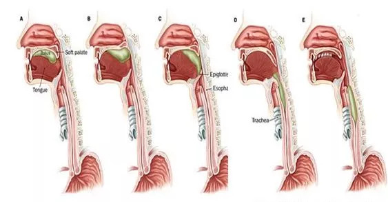 【专业知识】脑卒中后吞咽障碍的康复训练总结