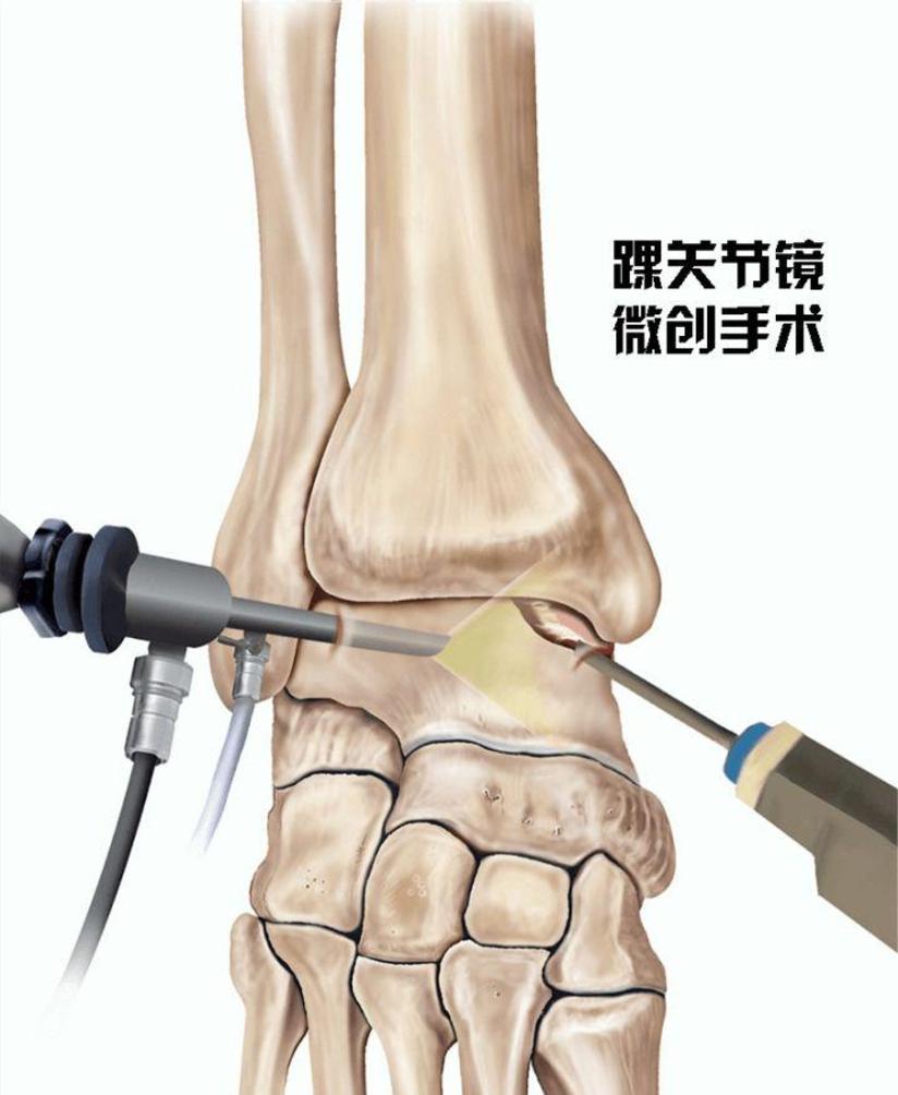 脚踝扭伤成习惯 可就真的伤不起 健康号 微医
