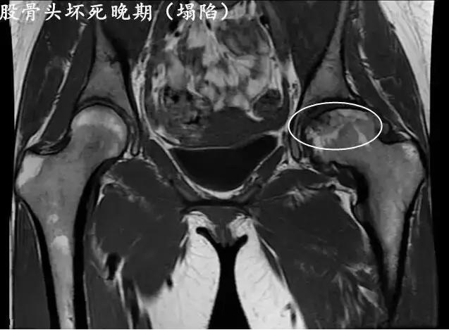 股骨頭壞死的這些早期徵兆,你中槍了嗎?