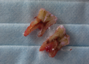 多年轻的牙齿劈裂了.