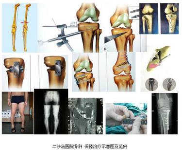二沙岛医院骨科---关节外科专业组简介