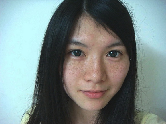颜值杀手——雀斑