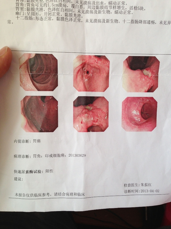 胃镜检查为什么要活检?