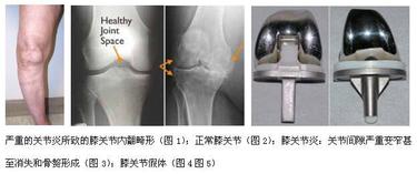 关节医院排名_手指关节图