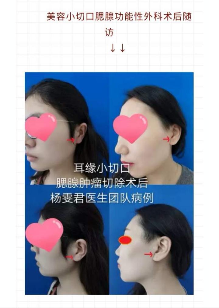 杨雯君教授耳前包块请当心腮腺肿瘤