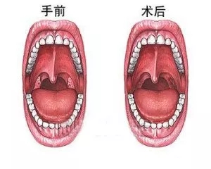 儿童喉咙正常图片