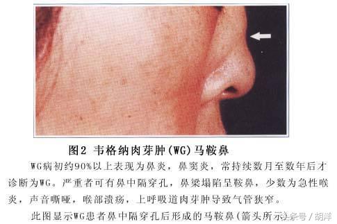 鼻子小器官，生病不容忽视，有可能预示肺部疾病，查查可能救下命