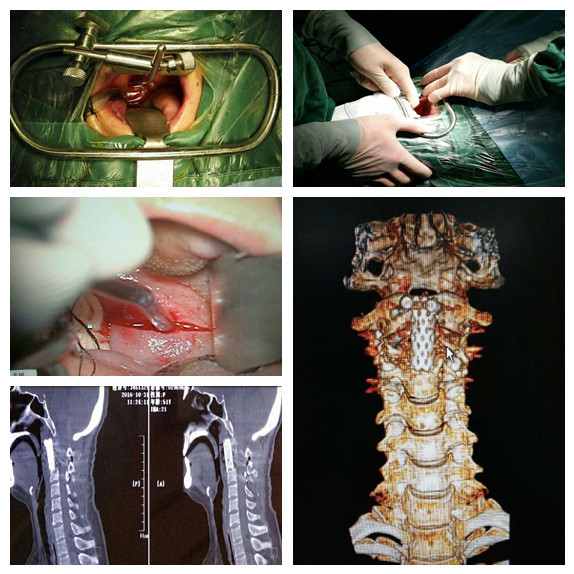 3d打印助阵,成功实施一例枢椎椎体转移瘤切除术