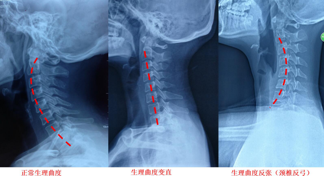 颈椎反弓是什么鬼?