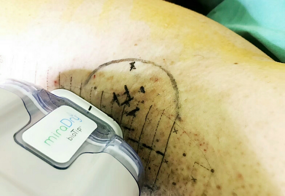 天方腋谭-S-miraDry