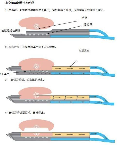 麦默通乳腺包块微创手术的适应症及禁忌症