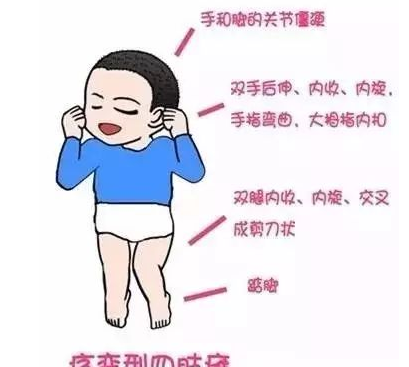 关于脑瘫的几个常见问题你都理解对了吗