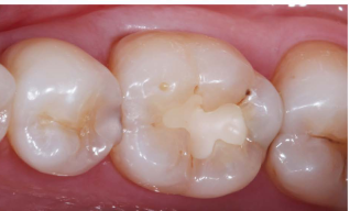 有一种补牙叫嵌体