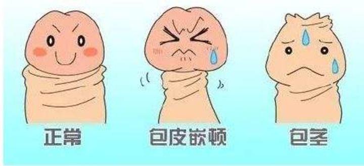 包茎是指包皮口狭小,不能上翻露出龟头.