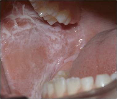 口腔黏膜炎症状图片图片