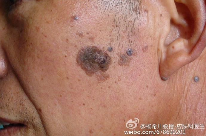 脂溢性角化,它也有个英文名叫做sk,常见于老年人,也叫作老年疣,但年轻