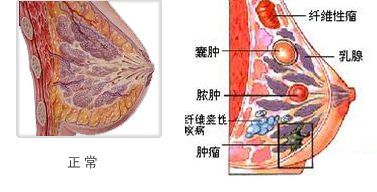 乳腺囊性增生的治療