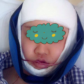 卢丙仑教授手术实例:v脸梦想成真