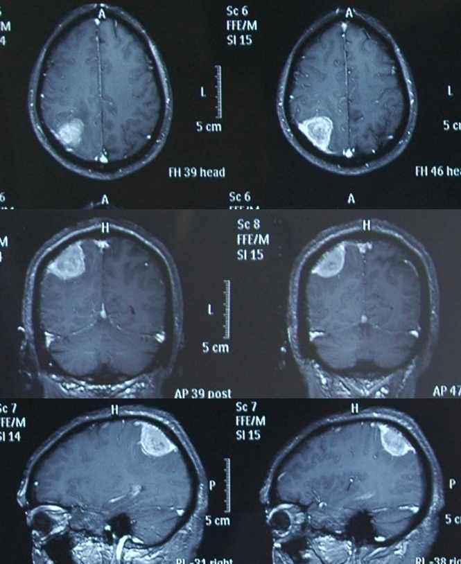 脑膜瘤照片图片