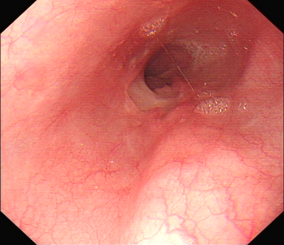 做胃镜有必要吗?