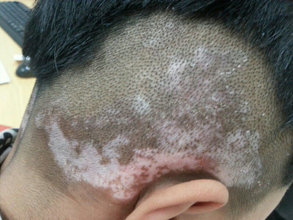 这种颜色的"胎记"可能会癌变