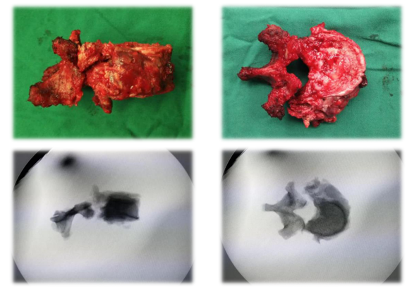 脊椎整块切除3d打印人工椎体植入手术_宁尚龙医生文章_天津医院-微医