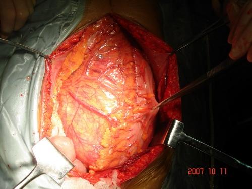 腹膜后肿瘤位置图片图片