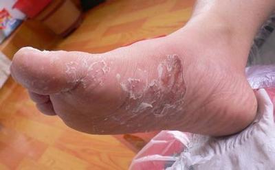 ▼手足癣是由致病性皮肤浅部真菌感染手部和足部引起的皮肤病