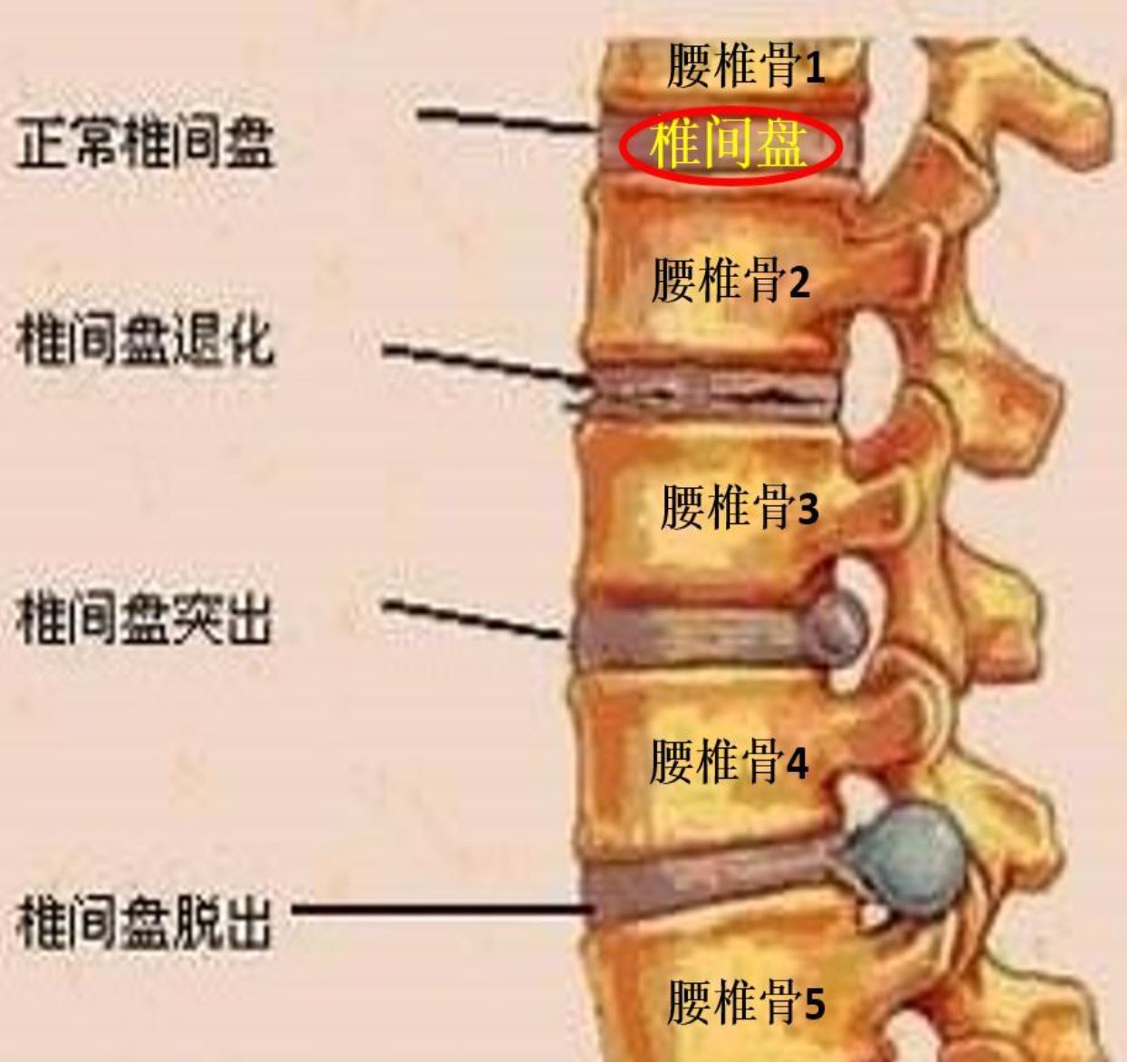 人的腰椎分5個節段,在腰椎和腰椎之間就是椎間盤(如下圖).