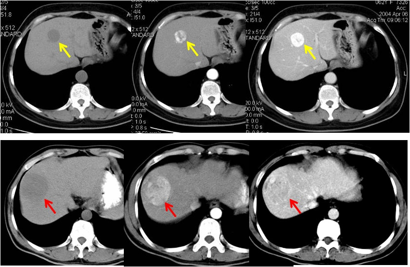 肝血管瘤要紧吗?