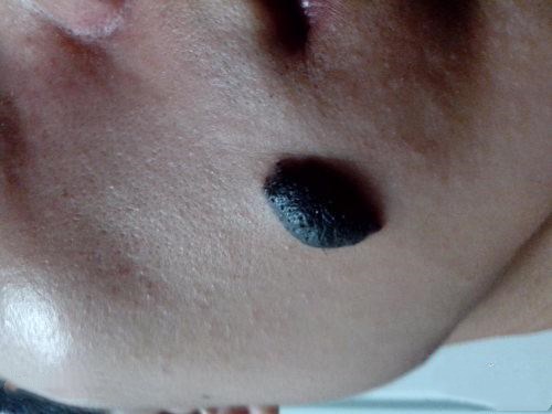 黑毛痣在哪些情况下容易恶变呢-微医