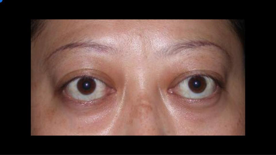 甲亢突眼手术-你不知道的故事