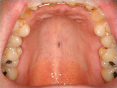 介绍发生于口腔黏膜的色素痣