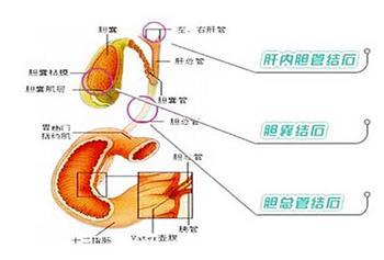 专家揭秘胆总管结石腹痛的原因
