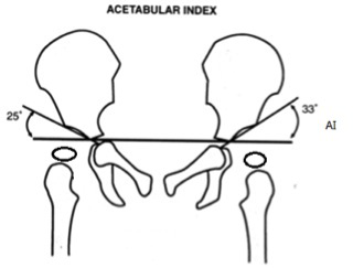 髋臼指数(ai)怎么啦?