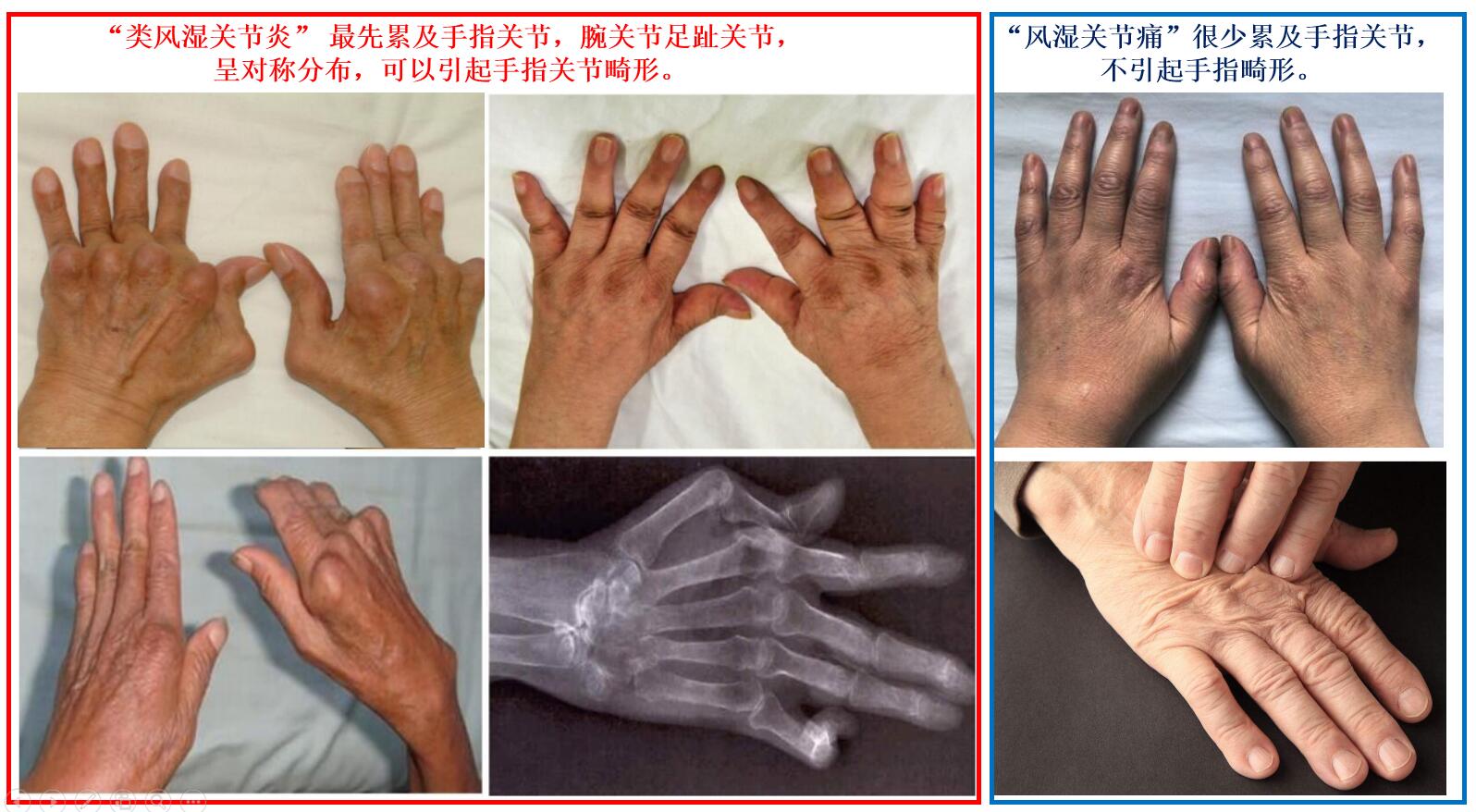 很少伴有发热,病变特点为缓慢持续性关节破坏,病变 最先累及手指关节