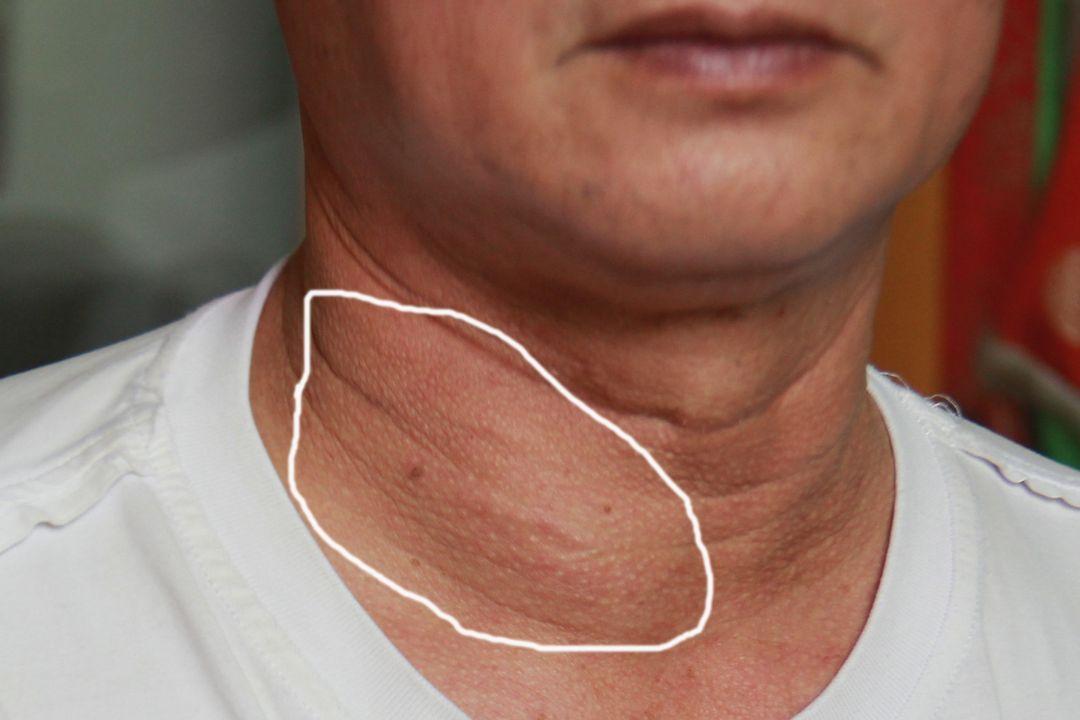 那么,什么是亚急性甲状腺炎呢?