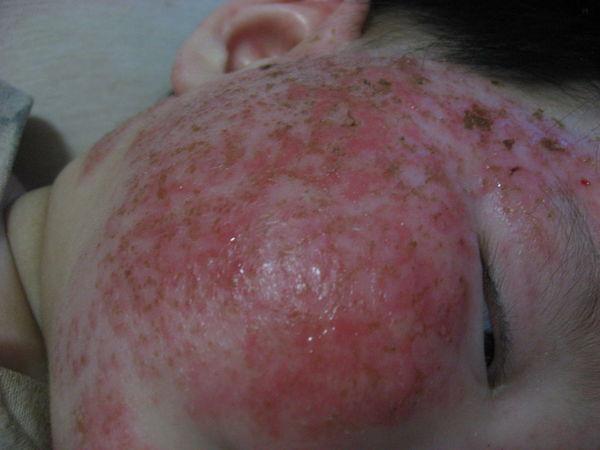 婴儿湿疹漫长的诊治过程,需要的是耐心,信心和细心!