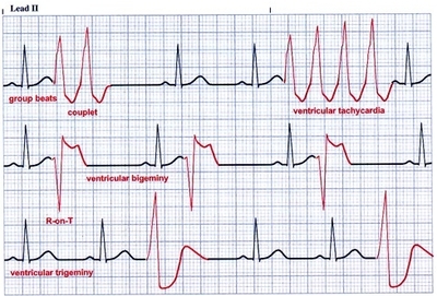 原创室性早搏到底离我们有多远?
