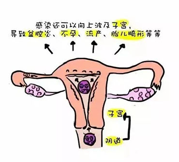 【有问必答】(上篇)妇科炎症知多少,如何对付阴道炎,宫颈糜烂,盆腔炎?