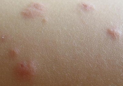 湿疹皮炎生活护理需注意