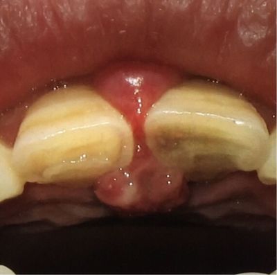 牙龈肿瘤症状图片
